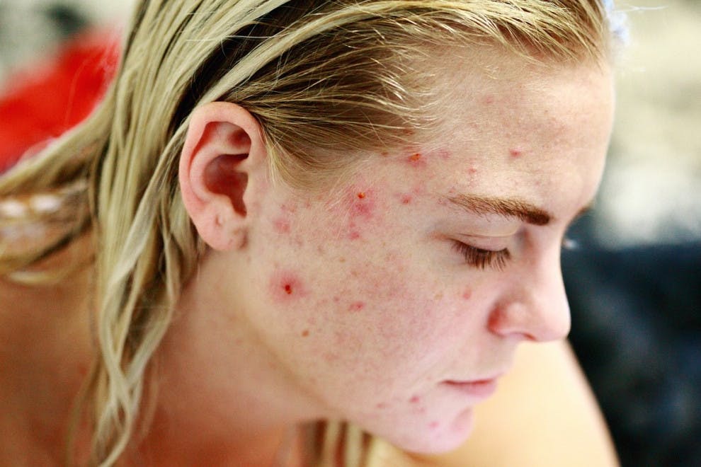 10 falsos mitos sobre el acné (desmentidos por la ciencia)
