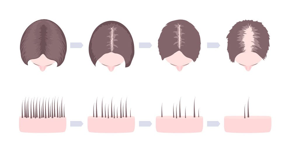 Alopecia Androgénica