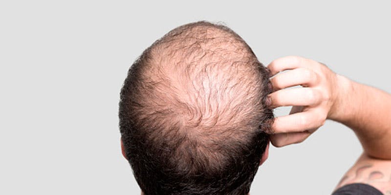 Alopecia Difusa