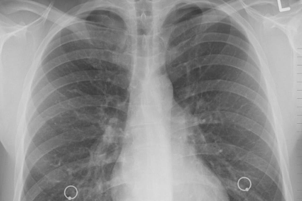 Radiografía Pulmones