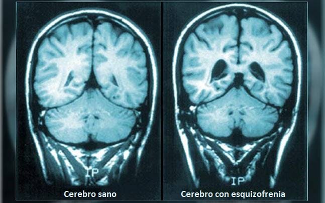 Cerebro con esquizofrenia