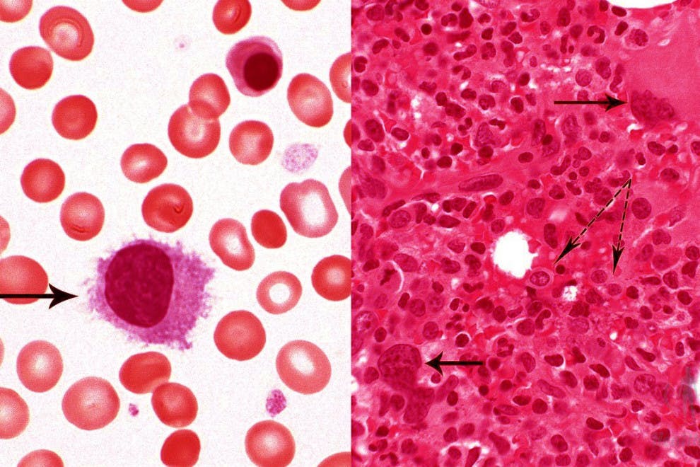 Hemoglobina Alta